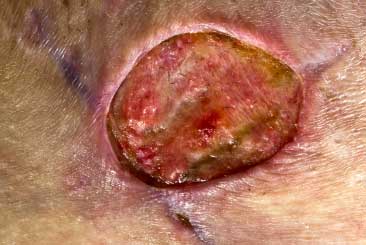 Methicillen-resistant-staph