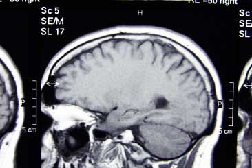 Brain-mri